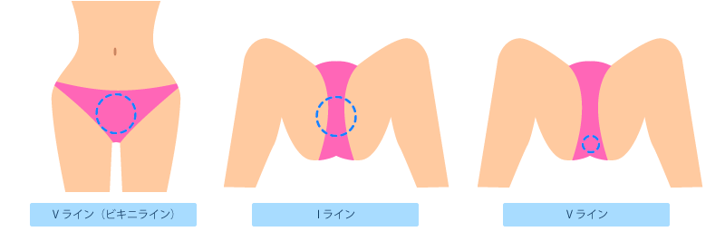 日本橋　脱毛  Iライン